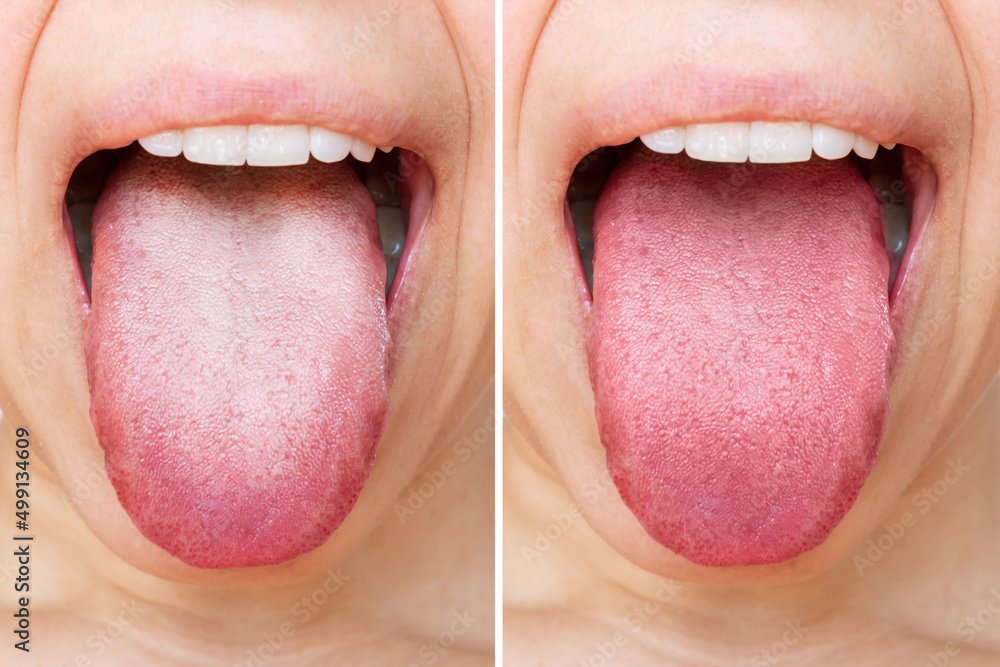 Female tongue with a white plaque. Comparison of a diseased tongue with a white plaque and a healthy clean tongue before and after treatment. The result of cleaning the tongue Stock Photo |